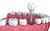Image Dental Implants
