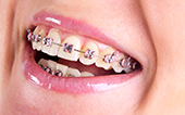 Image traditional braces prices laser