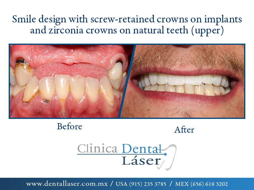 Image Before and after