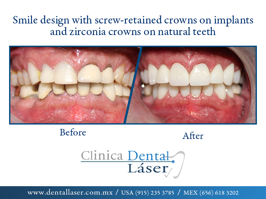 Image Before and after