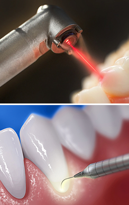 Image laserdentristy dentallaser
