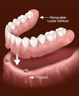 Image overdenture services