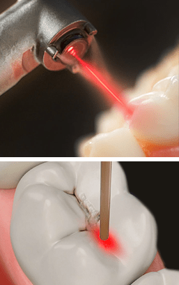 Image Laser Fillings services